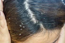 Dry Scalp/Dandruff information sheet